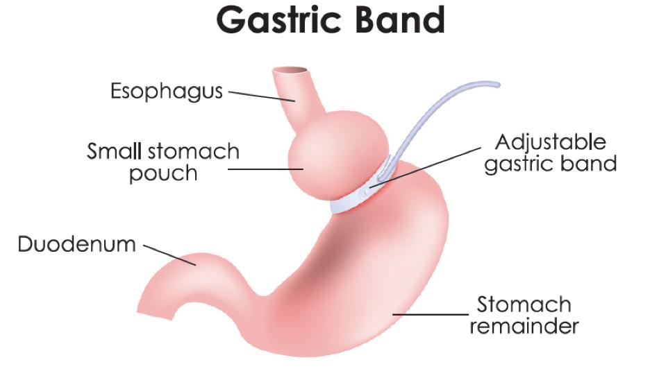 Adjustable Gastric Banding (AGB)