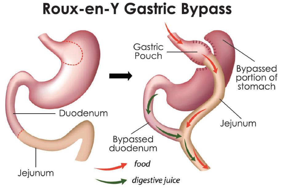 Roux-en-Y Gastric Bypass