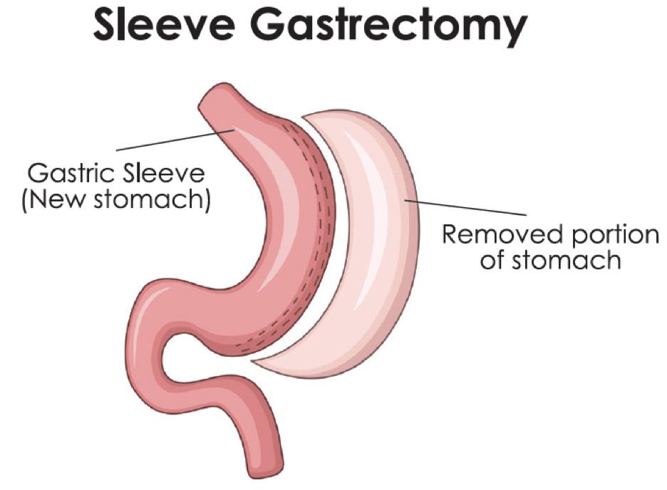 Sleeve Gastrectomy