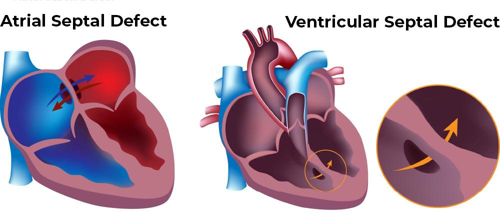 Types of Congenital Heart Defects