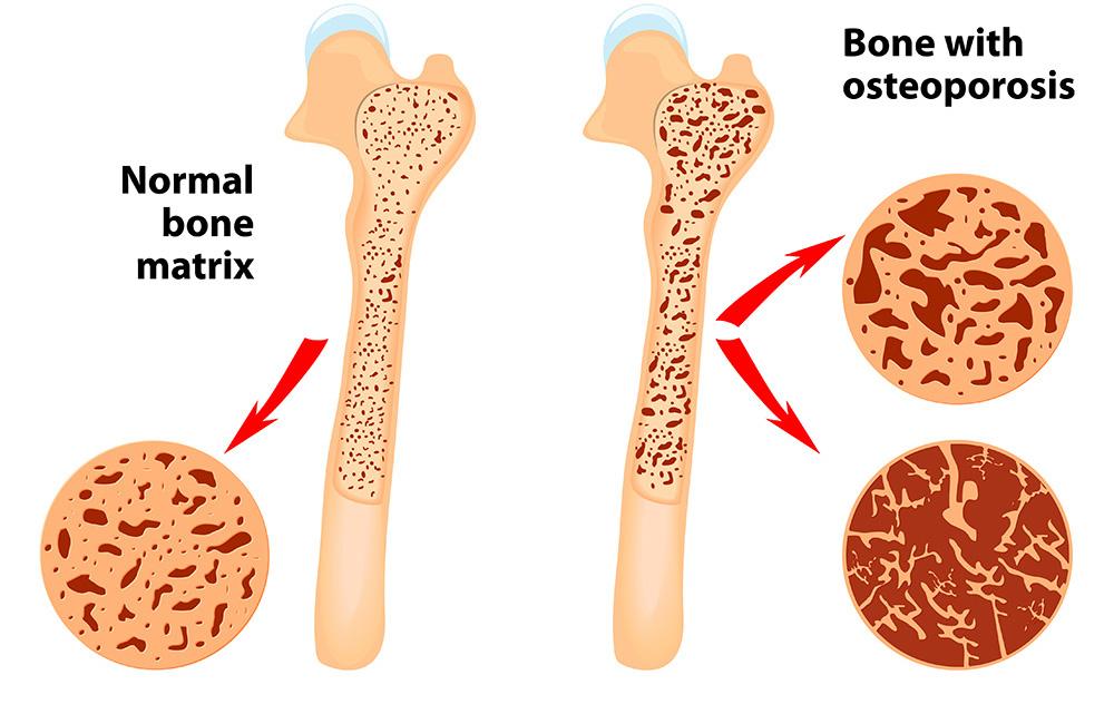 Osteoporosis