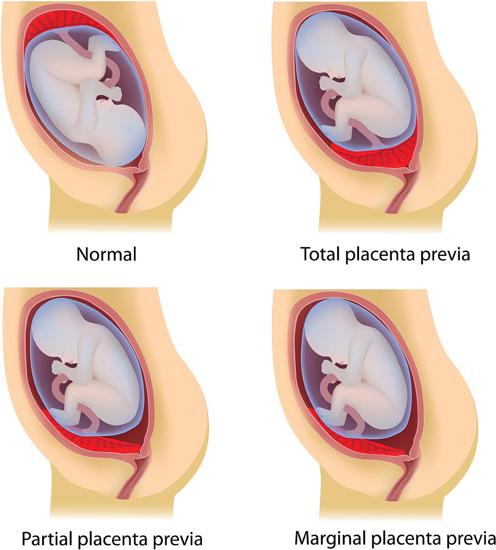 Types of Placenta Previa