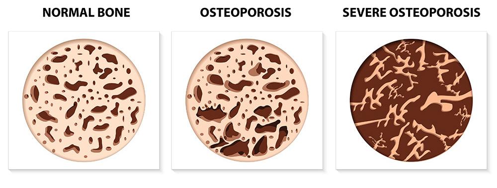 Stages of Osteoporosis