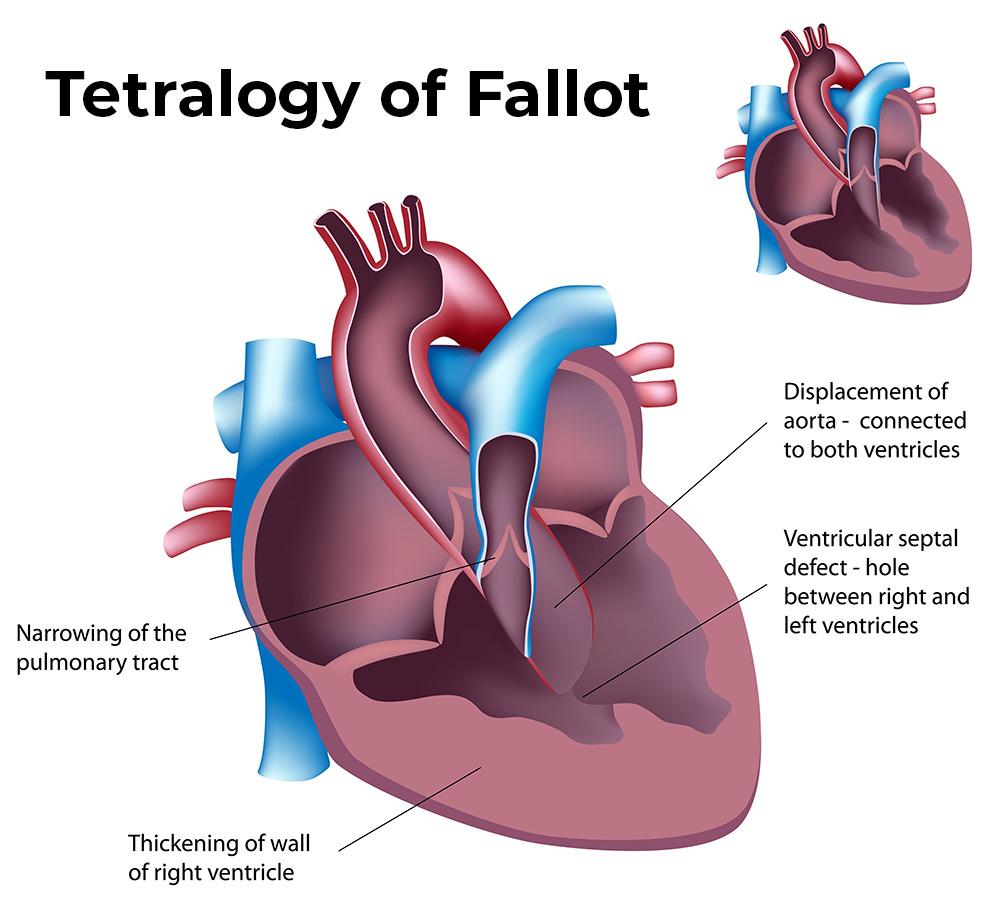 Tetralogy of Fallot