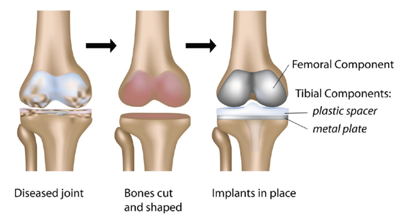 https://womenschoiceaward.com/uploads/blogs/March2021/Knee-Replacement.png